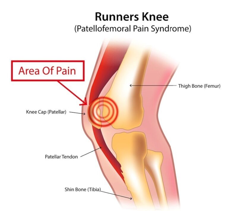 Runner Pain 5 Most Common Injuries During Running - My Physio & Rehab